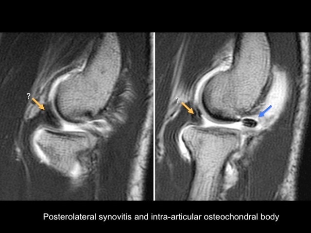 Figure 3 for case annular ligament of radius ( RID2048 )